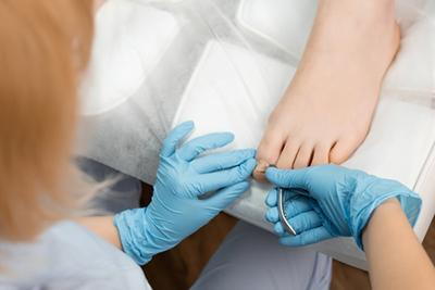 Close-up of podiatrist treating ingrown toenail on a patient's toe
