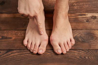 Person with bunion condition on foot