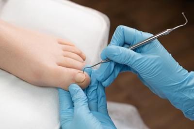 Close-up of ingrown toenail removal performed with a curette by a podiatrist