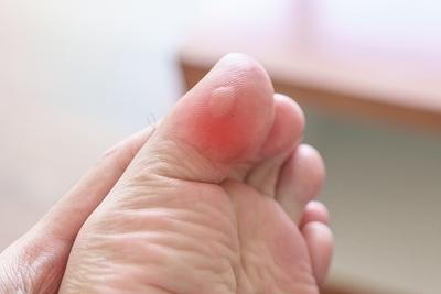 Blister condition on foot a person