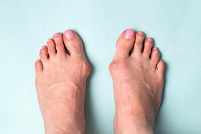 Woman presenting bunion condition on blue background.