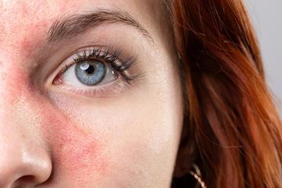 Woman-with-Rosacea