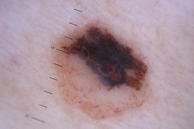 Dark-irregular-skin-lesion-with-measuring-scale