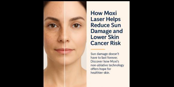 Moxi Laser