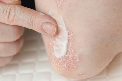 Topical treatment for psoriasis on affected skin