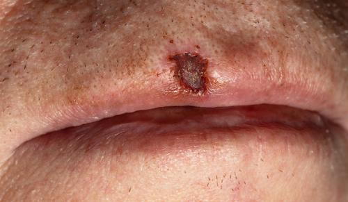 Close-up view of a patiet's lips affected by skin cancer.