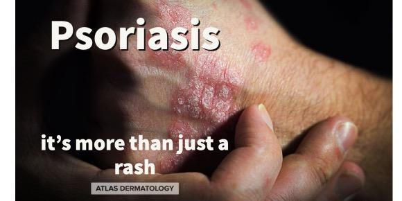 Psoriasis is more than just a skin condition