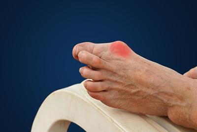 Man's-Foot-with-Bunion-Foot-Condition