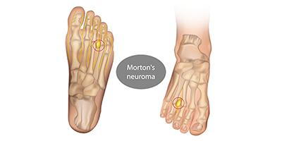 Illustration of inflamed nerve in Morton’s neuroma foot condition