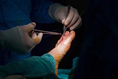Podiatric surgeon operating on toe deformity to relieve pain and restore foot function