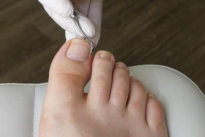 Ingrown Toenail in a persons foot