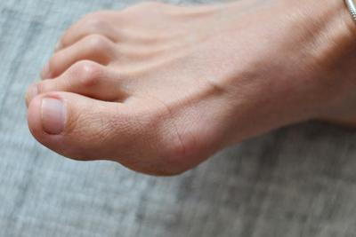 Illustration of hammertoes condition on person