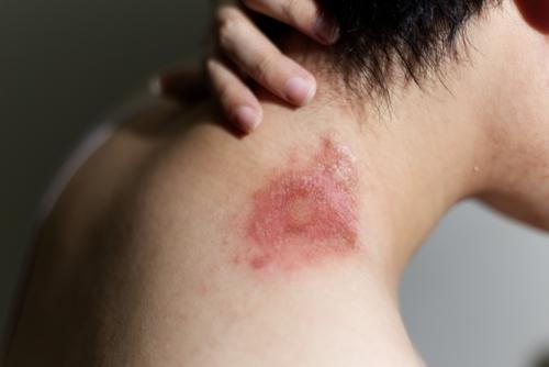 Man with eczema on shoulder with redness