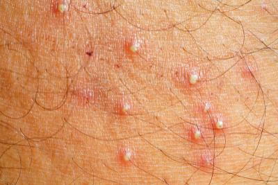 Illustration of Folliculitis on skin of a person
