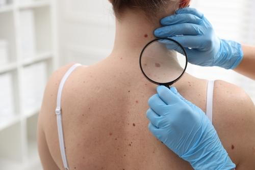 Dermatologist examines changing mole of a patient