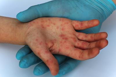 Hand-Foot-and-Mouth-Disease-on-Child's-Hand