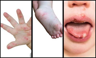 HFMD in a child showing hand, foot, and mouth lesions.
