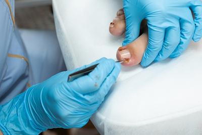 Podiatrist-Treating-Patient-with-Recurrent-Ingrown-Toenail