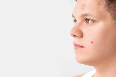 Teen-Acne-Problem