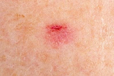 Skin infected probably a skin cancer with redness