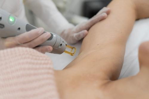 Woman receiving laser hair removal on armpit