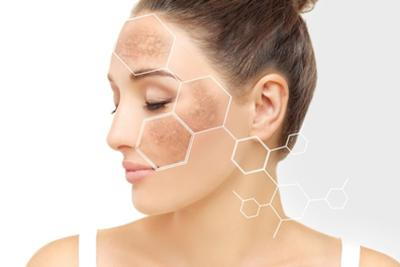 Illustration of hyperpigmentation on skin of a woman