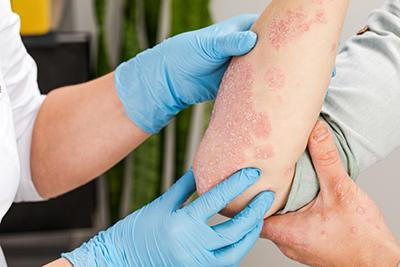 Eczema Treatment Raleigh Nc