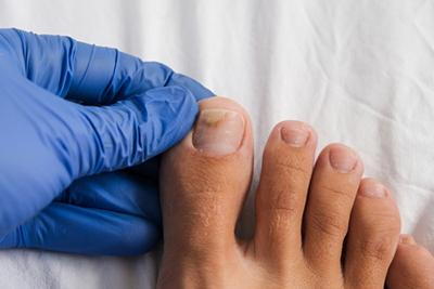 Feet-with-Fungus-Toenail