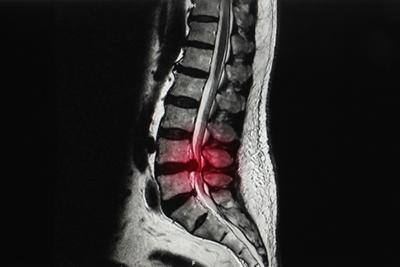 MRI scan showing sciatica in lower spine