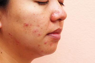 Womans face with severe acne on face