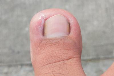 Man-with-Ingrown-Toenail