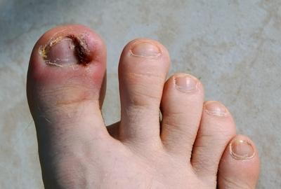 Severe Ingrown with wound and swelling finger.