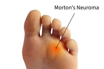 Illustration of Morton's Neuroma on foot.