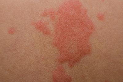 What Causes a Skin Rash? What is Contact Dermatitis? - Adv