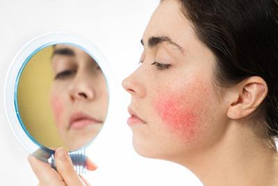 Woman-with-Rosacea-on-her-Cheek