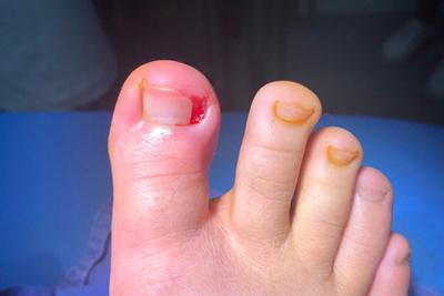 Ingrown-Toenail-After-Surgery