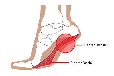 Drawing of Planter Fasciitis with label
