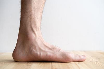 Side view of a foot with flat feet condition.
