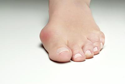 Bunions condition on a patients foot