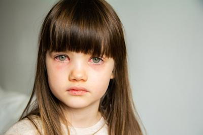 Child-with-Conjunctivitis