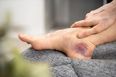 Close-up of sprained ankle showing discoloration