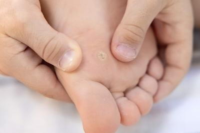 Illustration of Foot calluses on foot