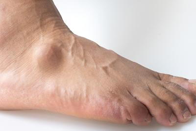 Man-with-Foot-Cyst