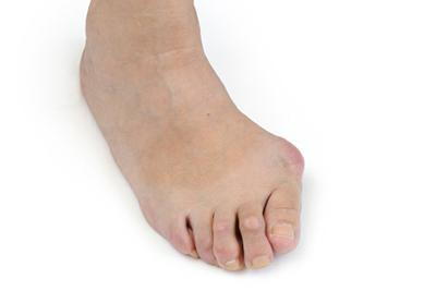 Close-Up-Picture-of-Bunions-on-Foot