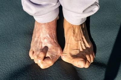 Person on the sun with bunion condition in feet