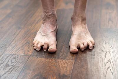 Hammertoes condition in a person in the wooden floor.