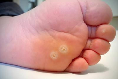Illustration of Plantar Warts on foot