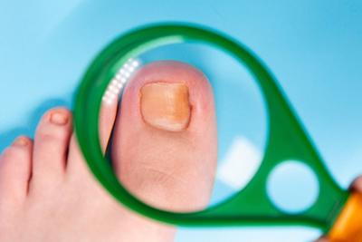 Magnifying Ingrown toenail on a person foot