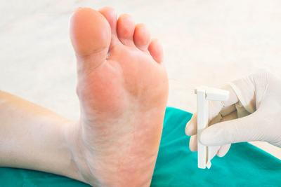 Illustration of Charcot Foot condtion