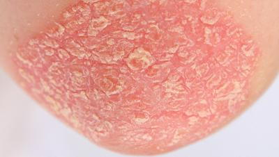 Severe-Eczema-in-person's-skin.